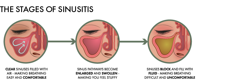 Stages of a Sinus Infection